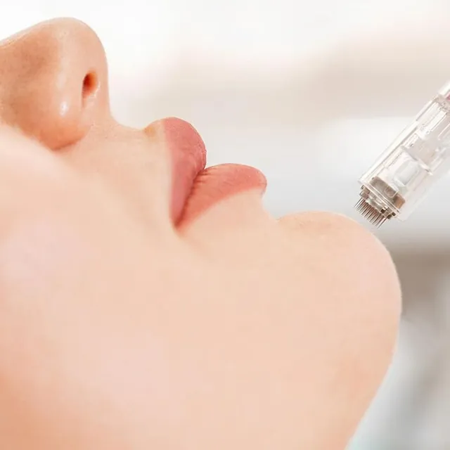 Microneedling: Das Gerät mit den feinen Nadeln setzt am Kinn einer Frau an